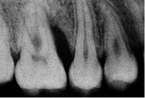 Atrofia Periodontal